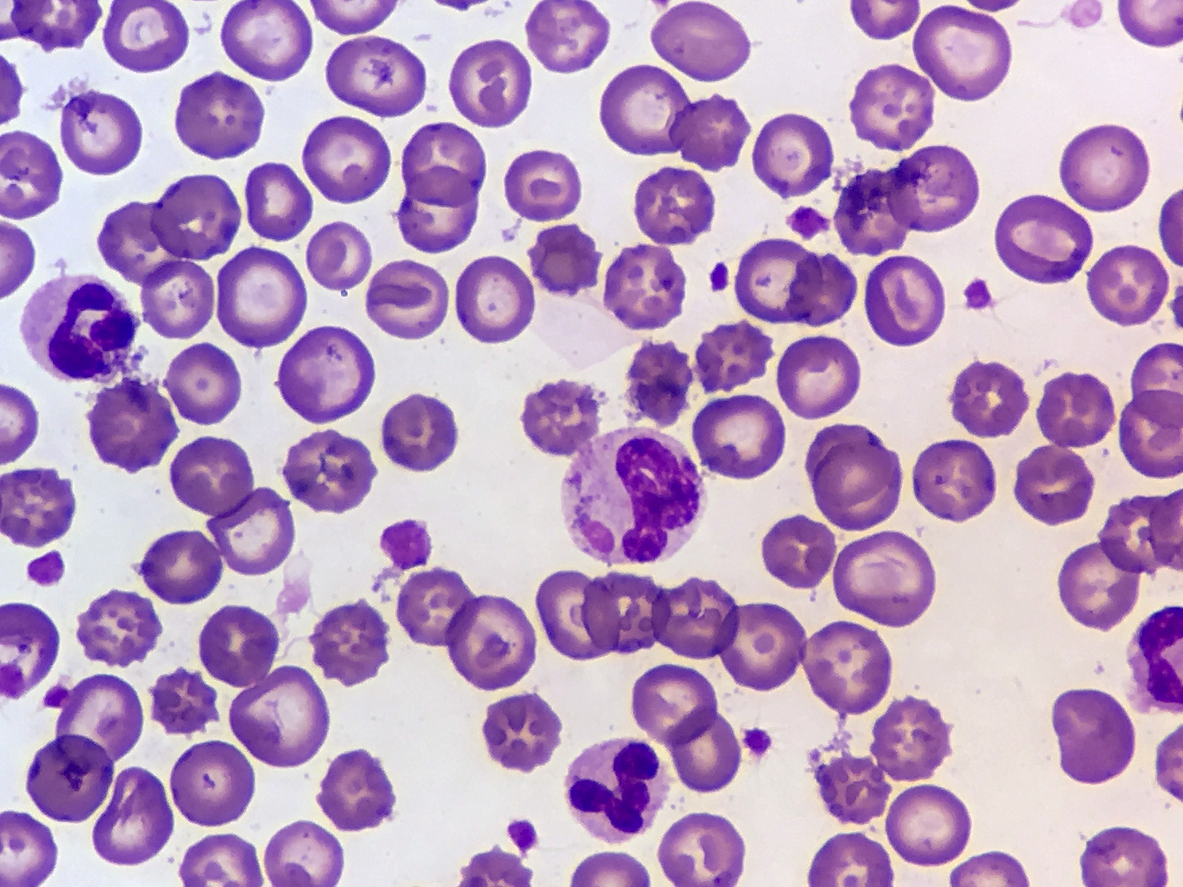 Canine Distemper virus cytoplasmic inclusion body within a neutrophil (blood smear, Wright's Stain). This was found on the blood smear of a 1-month-old, female, mixed breed puppy that presented with signs consistent with upper respiratory disease and conjunctivitis.  Diagnostics revealed that the dog had leukocytosis (23,200 WBCs/ul), anemia (PCV 22.2%), and hypoproteinemia (total protein 5.4 g/dl).